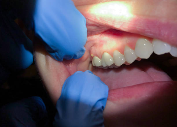 Best Dentist for Tooth Abscess  in New Chicago, IN